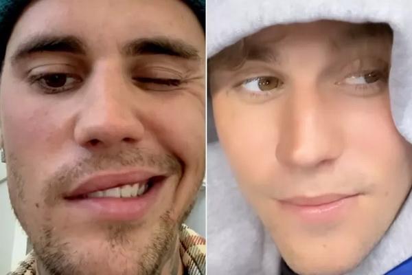 Justin Bieber Beri Kabar Terbaru Mobilitas Wajahnya Akibat Sindrom ...